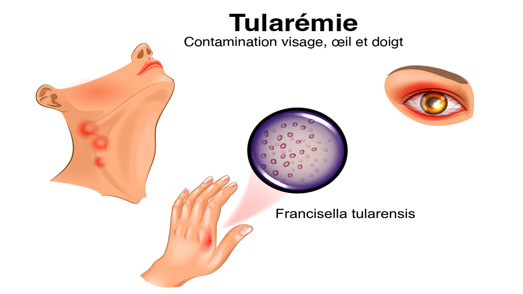 Contamination par ulcération visage, oeil et doigt