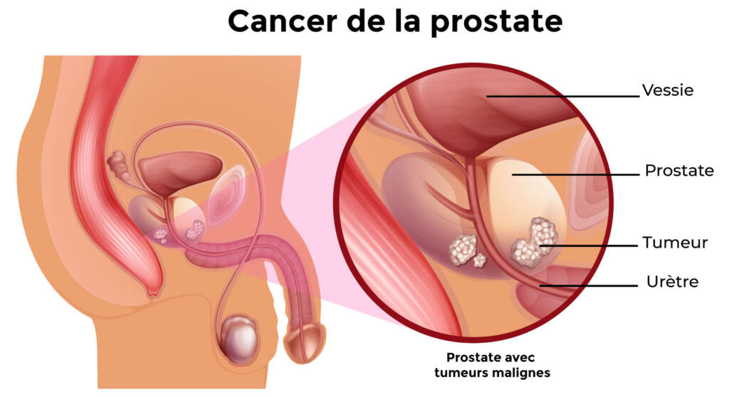 anatomie cancer de la prostate