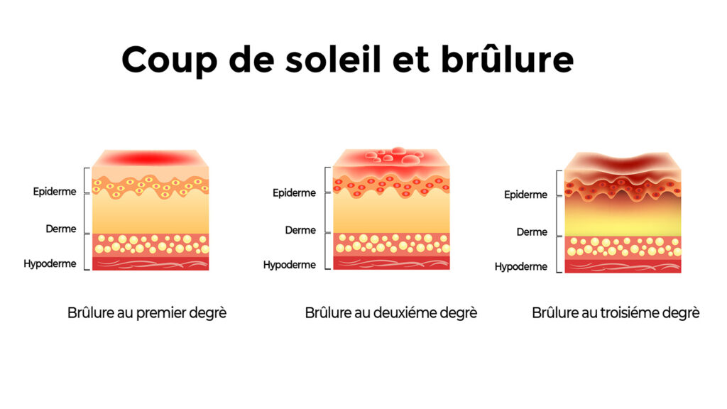 Coupe de la peau qui montre les trois stades des brûlures dues au soleil