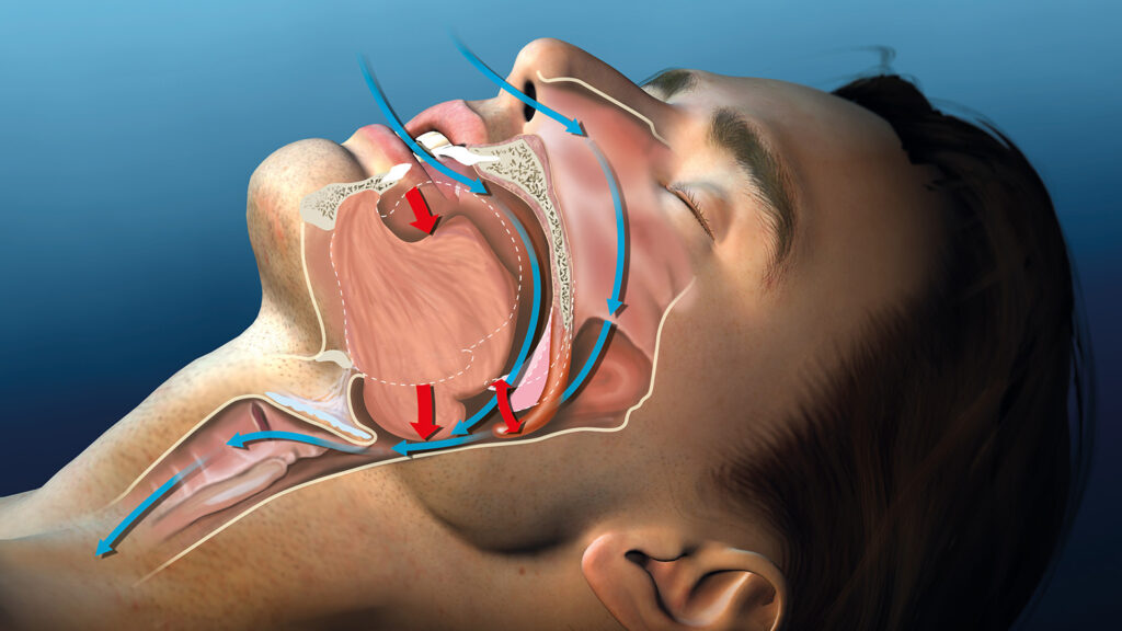 Schéma anatomique détaillé du ronflement et de l'apnée du sommeil
