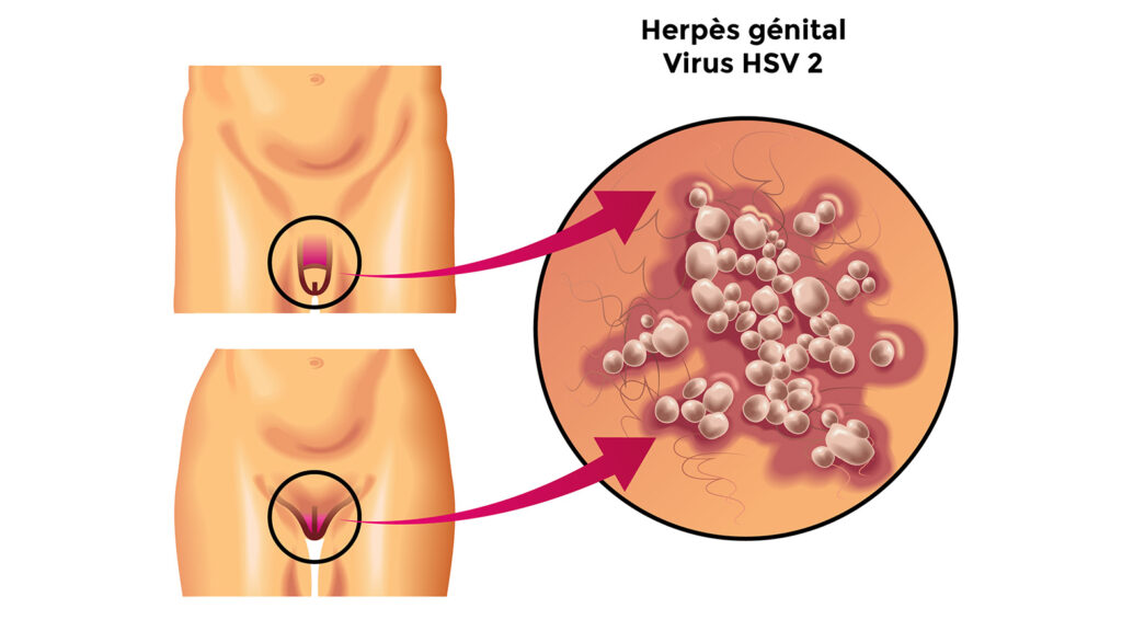 Schéma explicatif de l'herpès génital virus HSV 2.