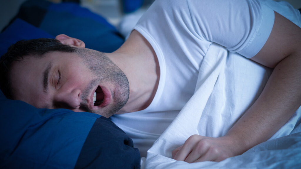 Homme dormant sur le dos en ronflant, illustrant les symptômes de l'apnée du sommeil