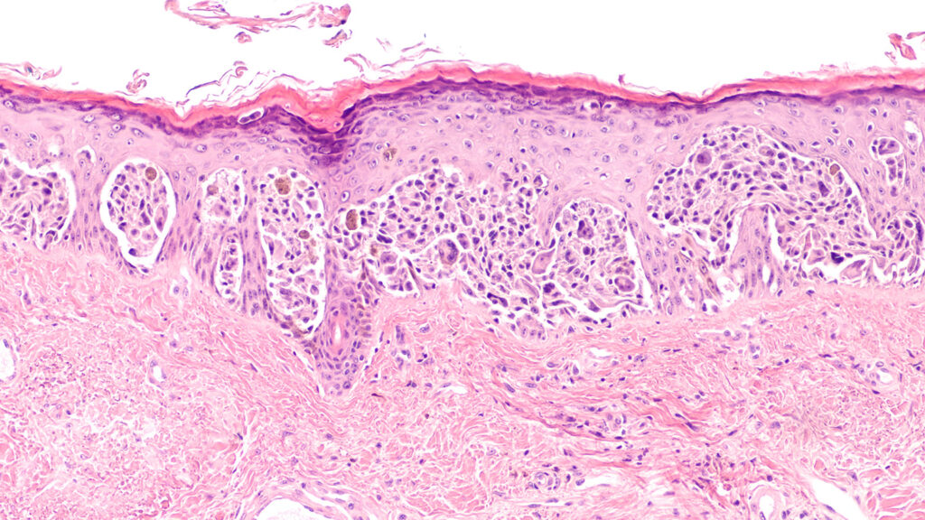 Image histologique d'un mélanome au stade épithélial