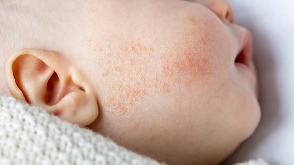 Visage d'un nourrisson avec de légères éruptions cutanées attribuables à la dermatite atopique.