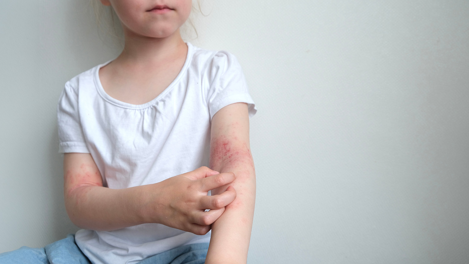 Enfant avec dermatite atopique sur les bras.