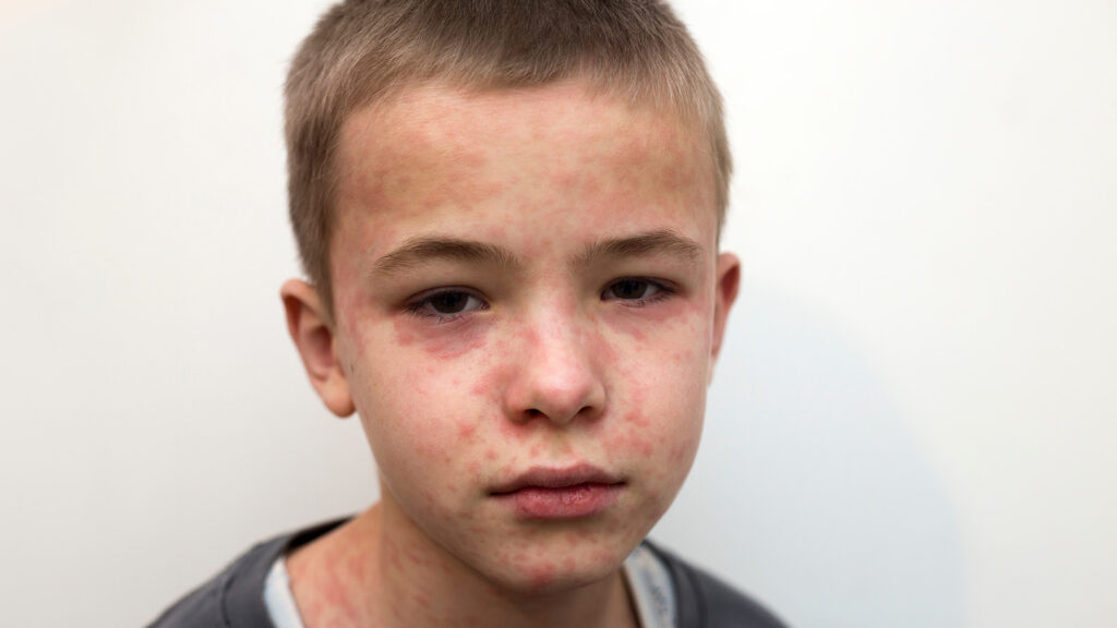 Visage d'un enfant avec des éruptions de rougeole.