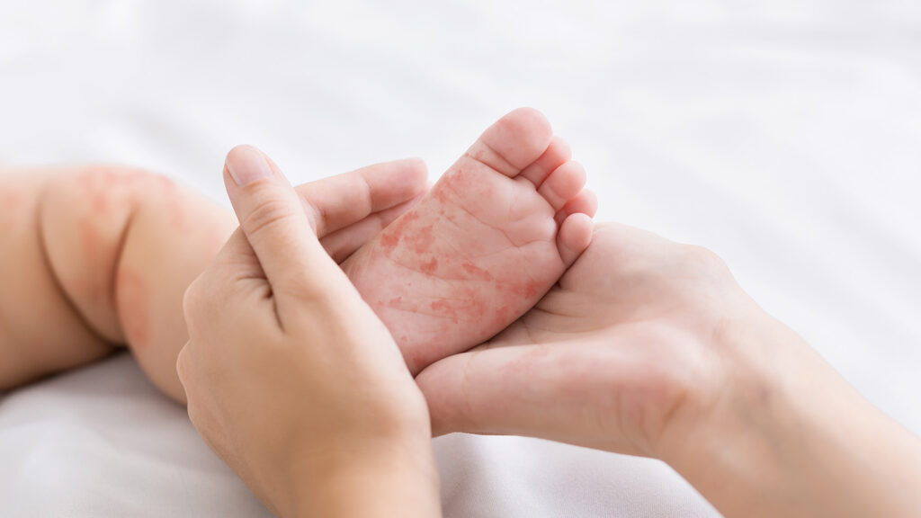 Pied d'un bébé avec des taches de rougeole.