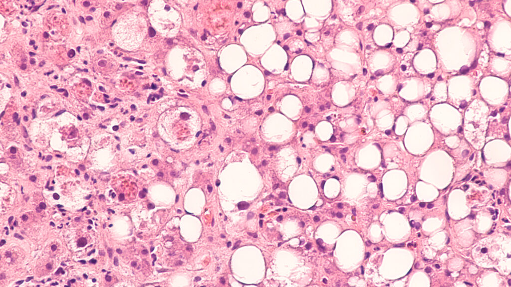 Micrographie d'une stéatose hépatique, visualisation des vacuoles lipidiques.