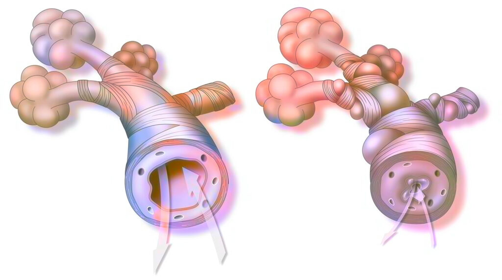 Illustration montrant la vasoconstriction des bronches lors d'une crise d'asthme.