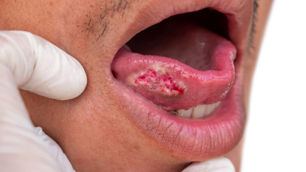 Ulcère rougeâtre et blanc sur le côté de la langue d'un patient lors d'un examen buccal par un professionnel de la santé