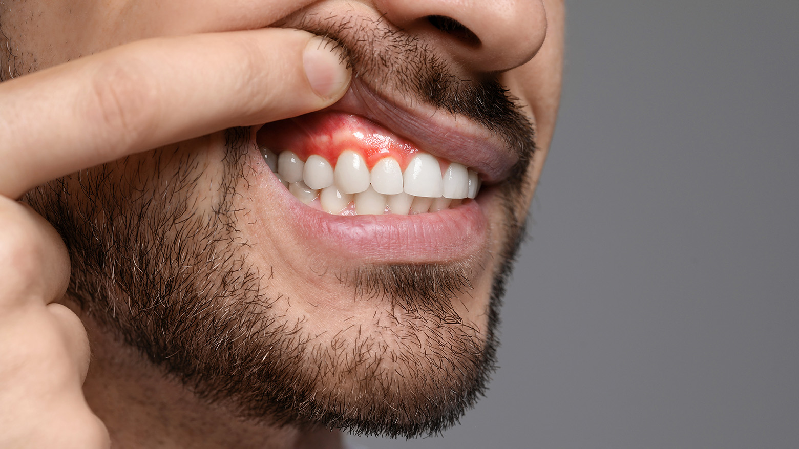 Gencives enflammées et saignantes sur le côté supérieur droit de la bouche d'un patient lors d'un examen par un dentiste.