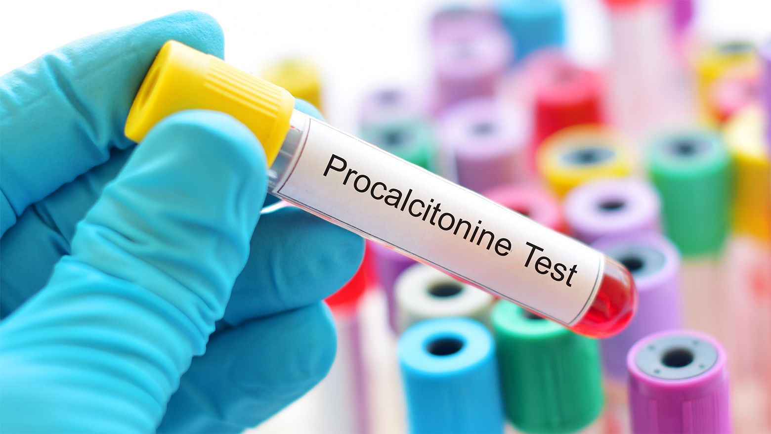 Échantillon de sang pour le test de procalcitonine