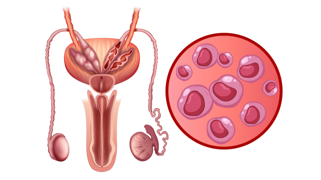 Schéma anatomique des organes reproducteurs masculins affectés par Chlamydia