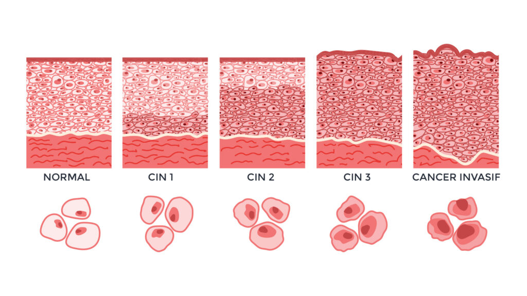 Illustration des différents stades de dysplasie cervicale, allant de normal à cancer invasif.