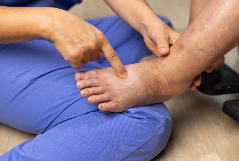 Examen médical d'un pied enflé avec le doigt pointant l'œdème.